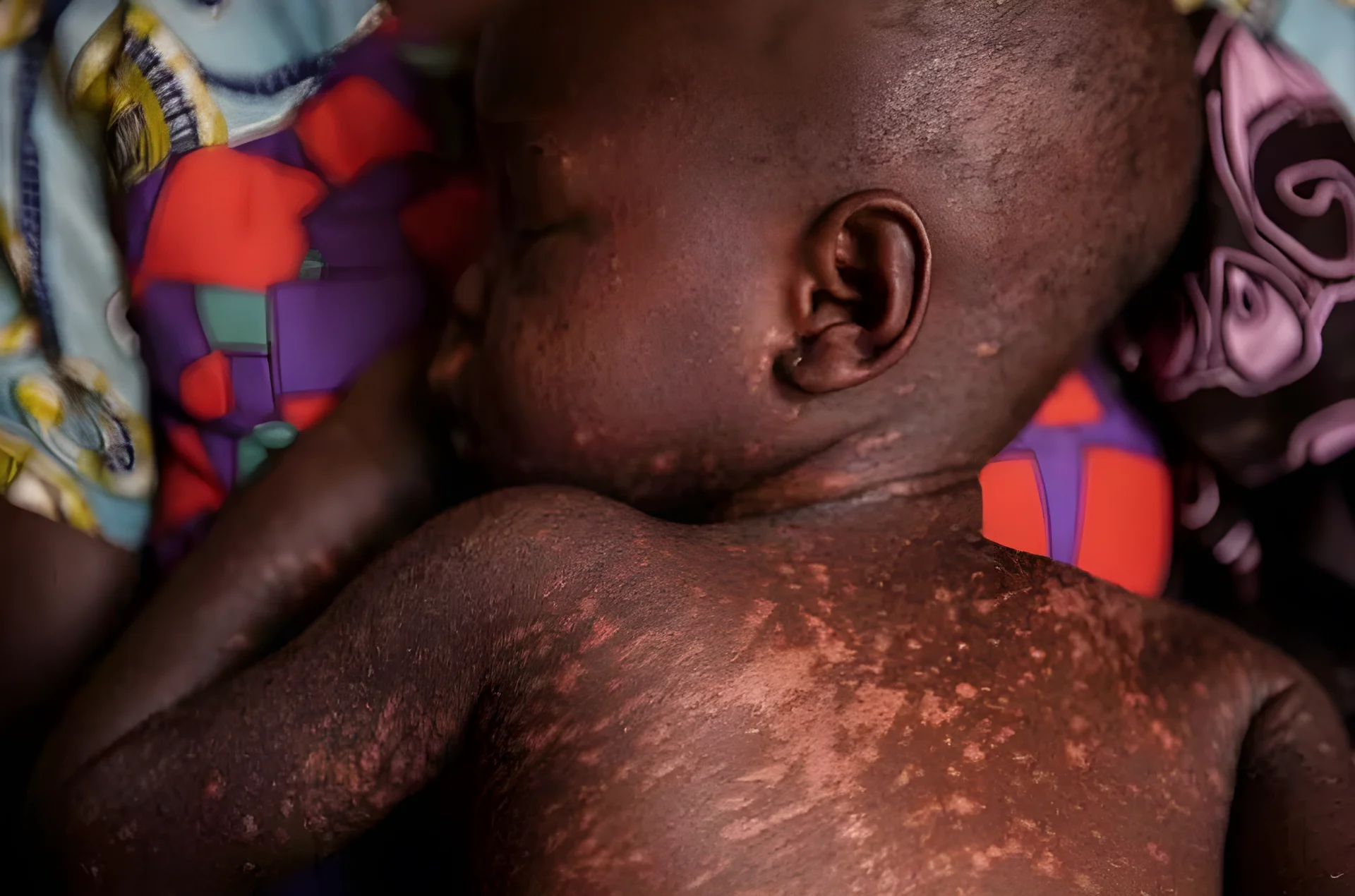 Measles Outbreak Claims 140,000 Lives in 2018, Health Officials Warn