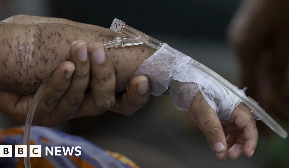 Over 500 Children Die in Months as Measles Cases Surge in Bangladesh