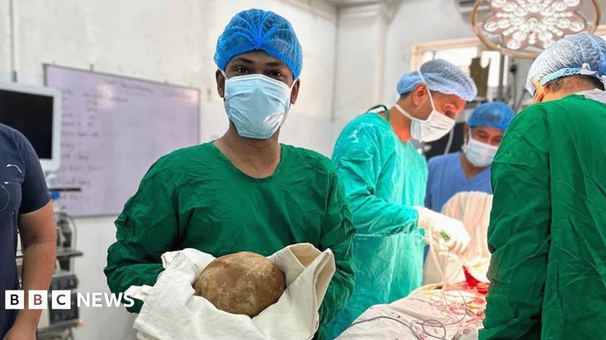 Doctors remove 3.1kg stone from man's bladder and claim record