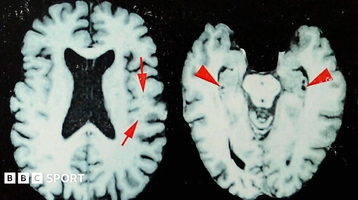 97.7% of Dead NFL Players Had Brain Disease, Study Finds
