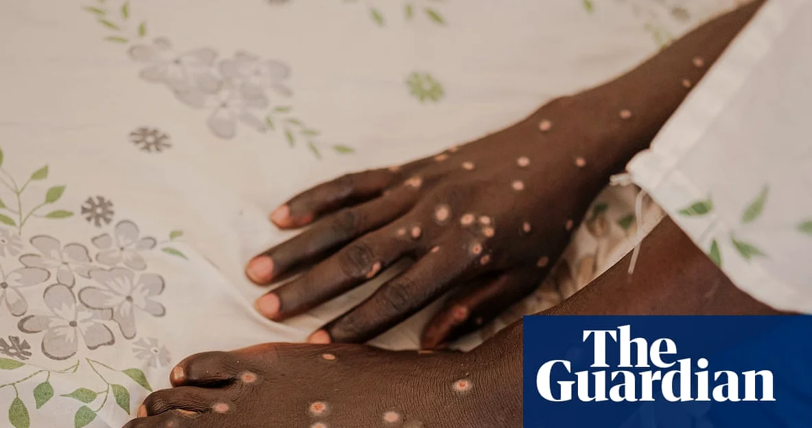 479 Mpox-Tote in Kongo: Ausbruch in neuen Ländern